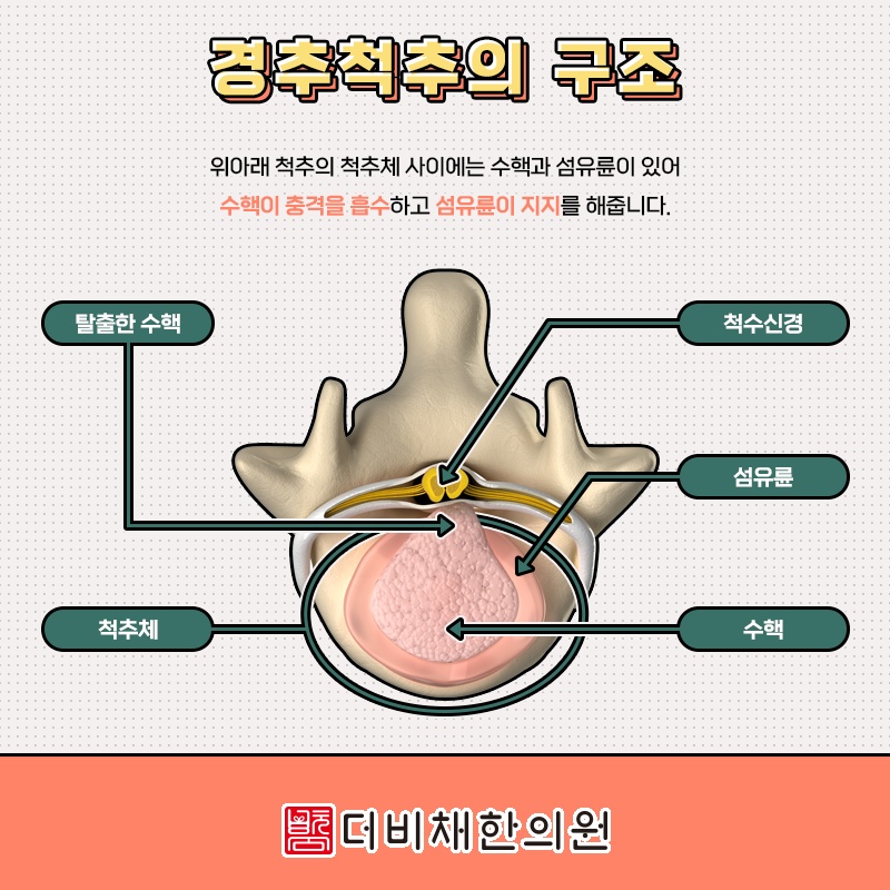 목디스크, 많은 경우 비수술적 관리로 증상 완화 가능성 살펴보기
