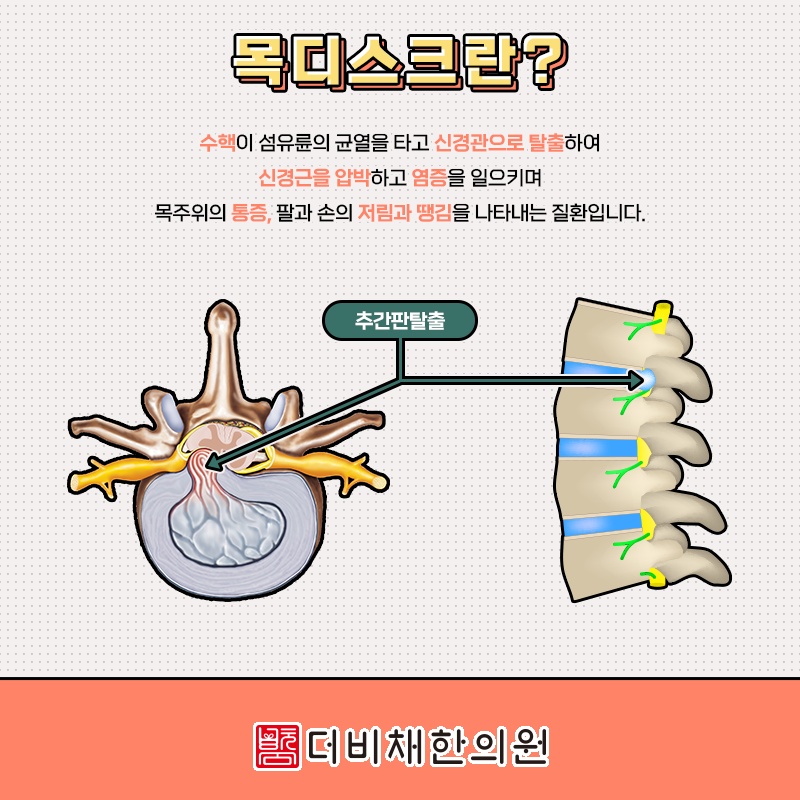 목디스크, 많은 경우 비수술적 관리로 증상 완화 가능성 살펴보기