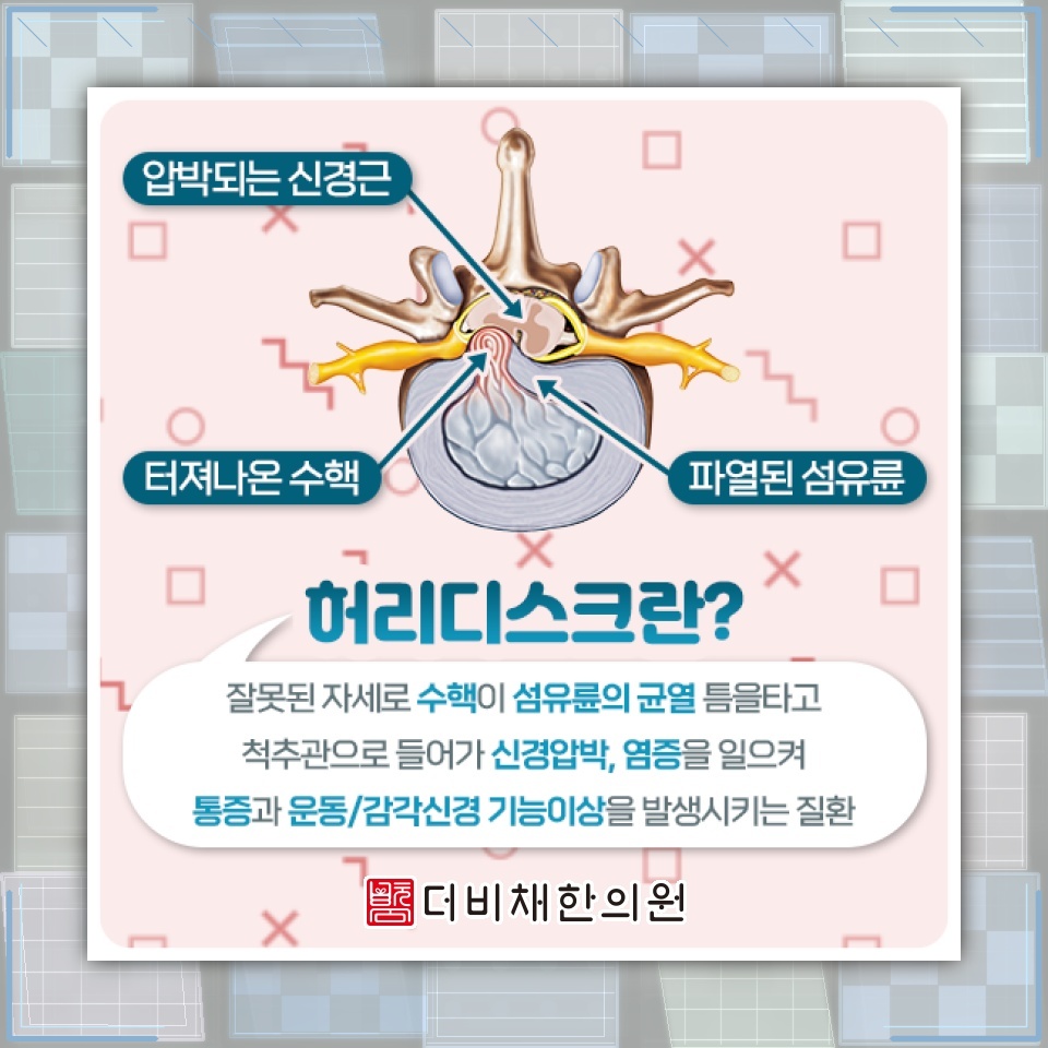 허리디스크로 다리 감각이 둔해지기 전 살펴볼 변화