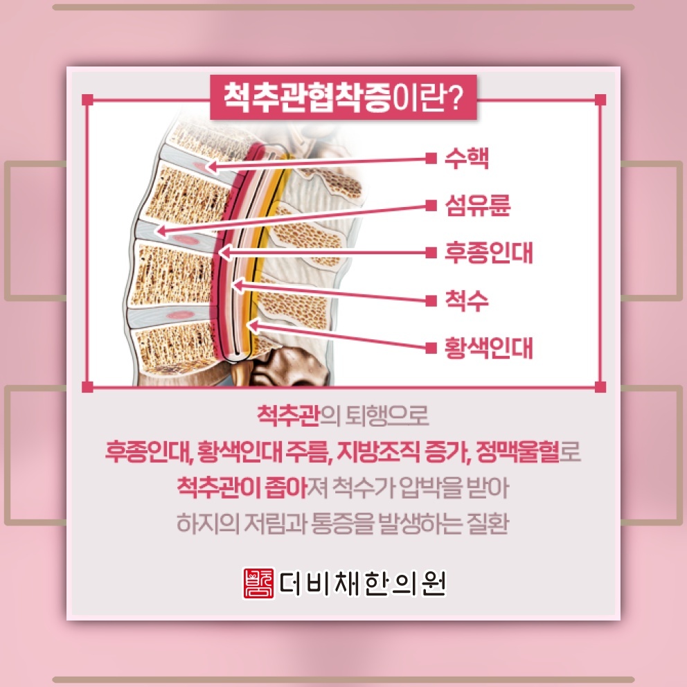 척추관협착증의 진행 과정과 알아두어야 할 주요 신호