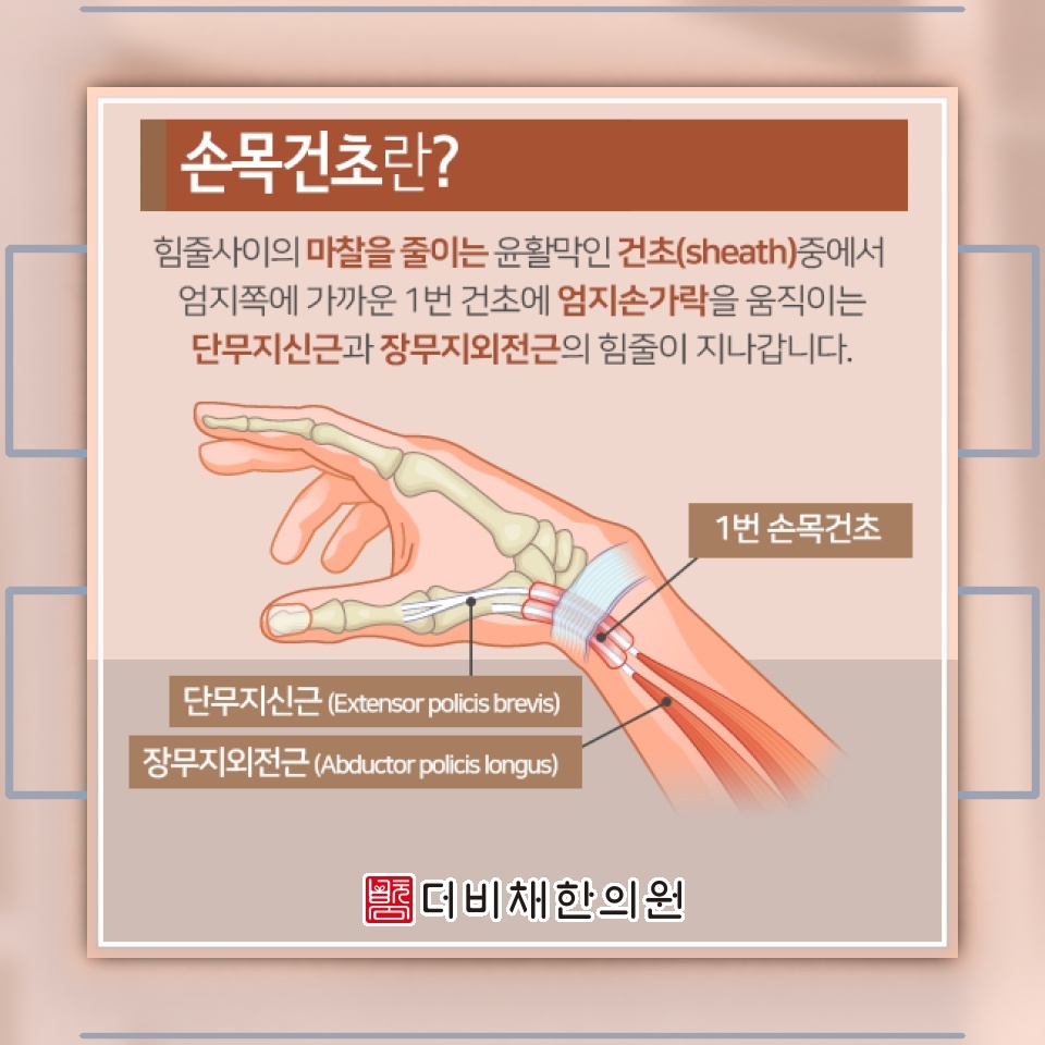 엄지손가락 동작에서 느껴지는 손목건초염의 불편함