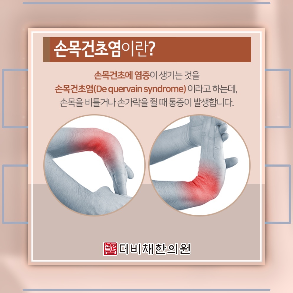 엄지손가락 동작에서 느껴지는 손목건초염의 불편함