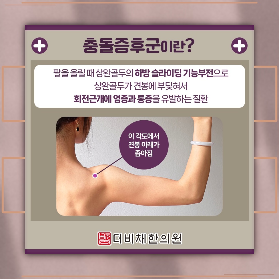 충돌증후군 통증 완화를 돕는 비수술적 관리 방법