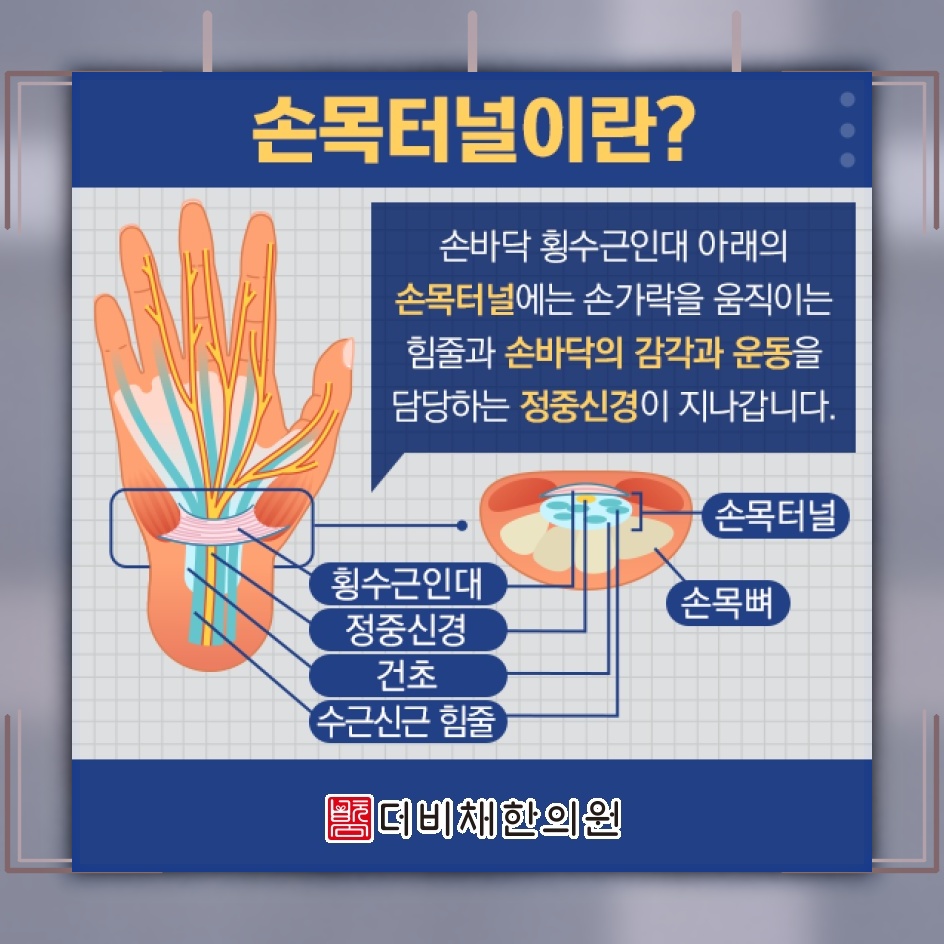 손목을 무리하게 쓴 뒤 나타나는 손목터널증후군 변화