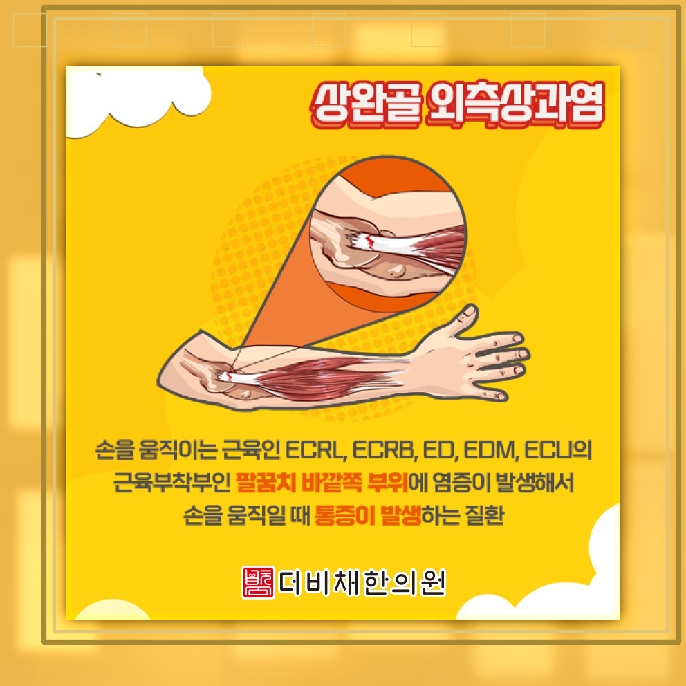 팔꿈치 바깥쪽이 시큰할 때 알아보는 테니스엘보
