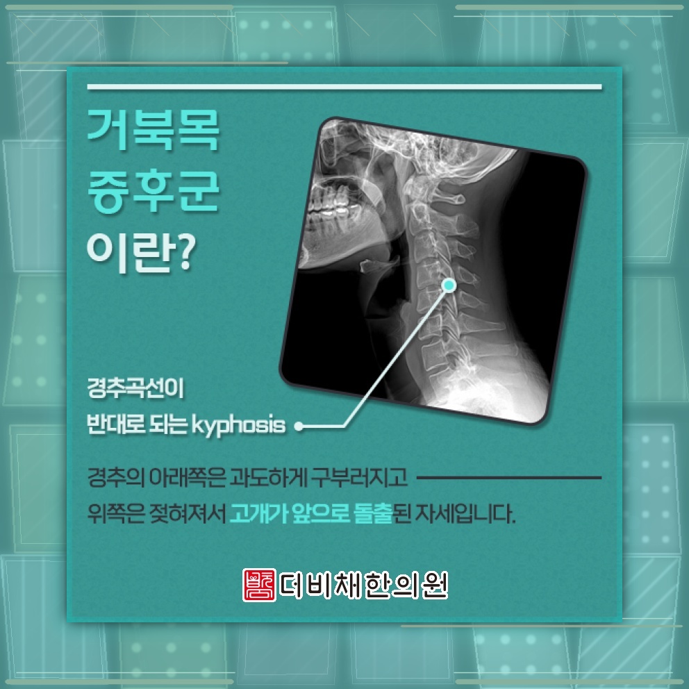장시간 컴퓨터 작업이 부르는 거북목증후군 살펴보기