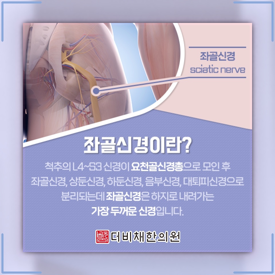 좌골신경통이 나타날 때 통증 양상과 일상 관리법