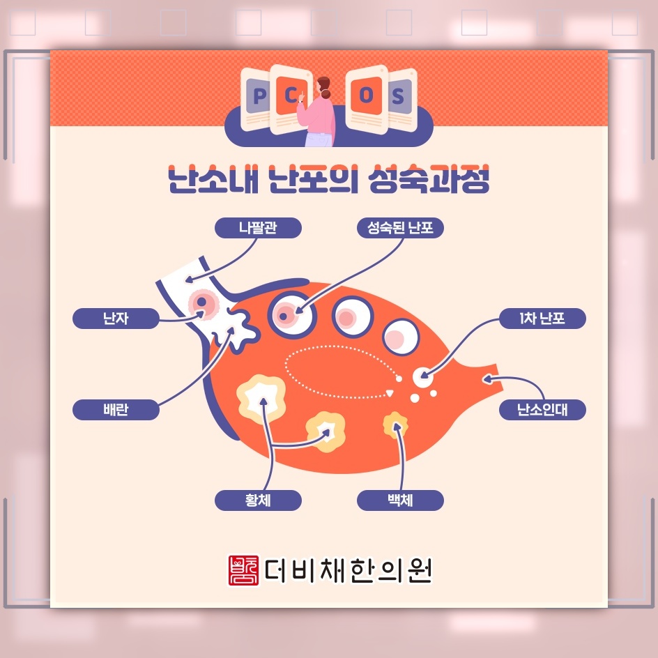 가임기 여성의 배란 이상과 관련된 다낭성난소증후군