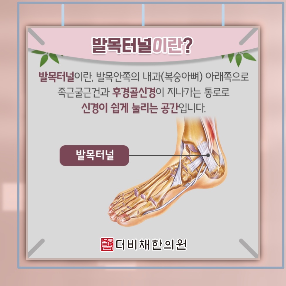 발목터널증후군에서 나타나는 발목 저림과 보행 불편.tensor