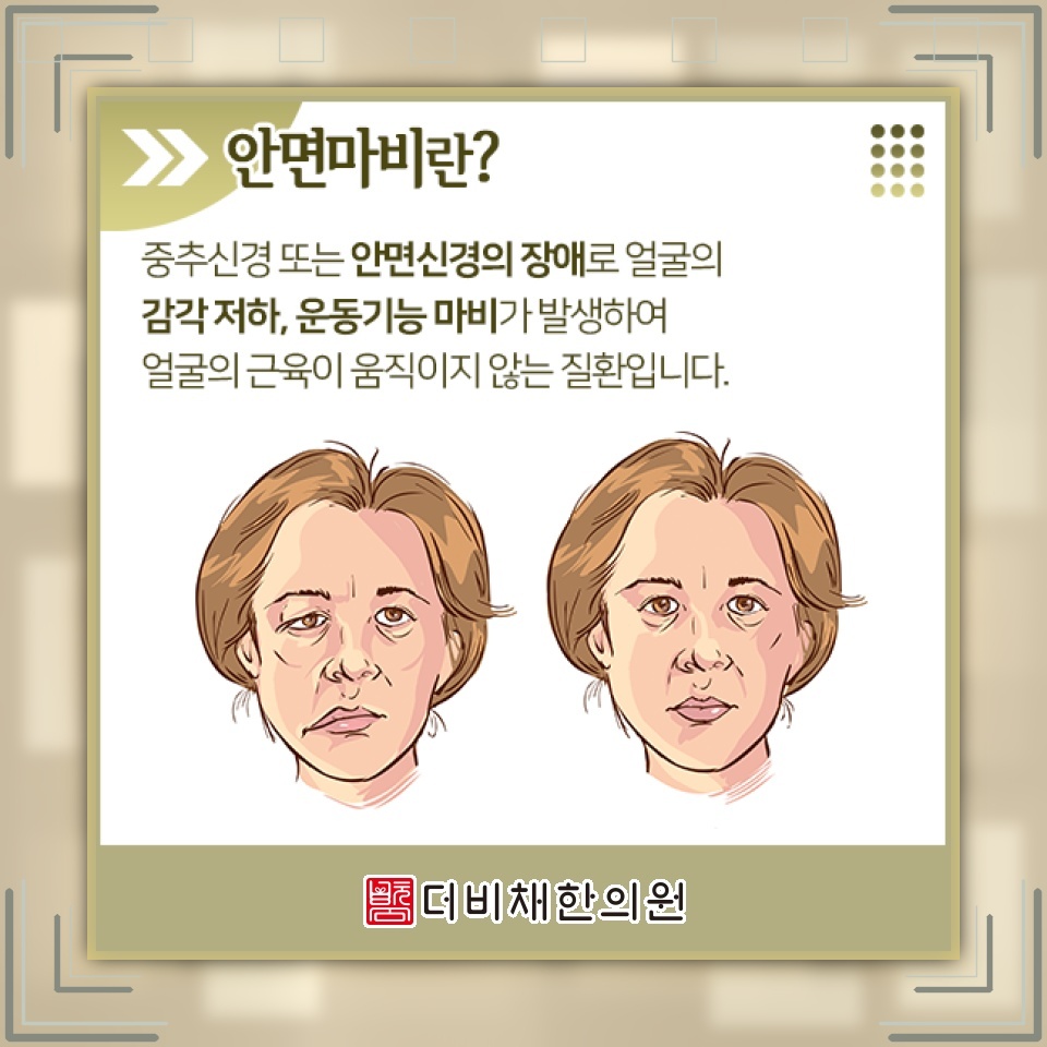 안면신경마비 초기에 살펴야 할 대응과 회복 과정