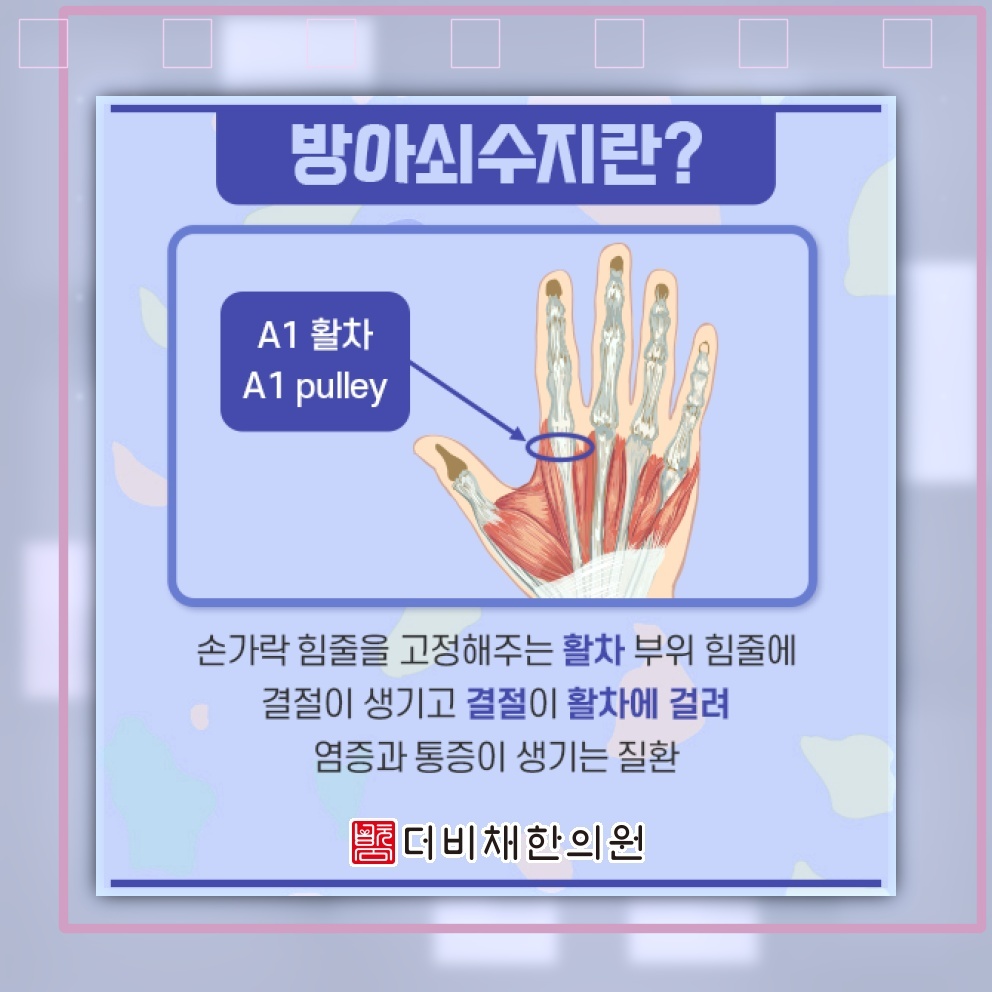 방아쇠수지로 손가락을 구부릴 때 느껴지는 걸림
