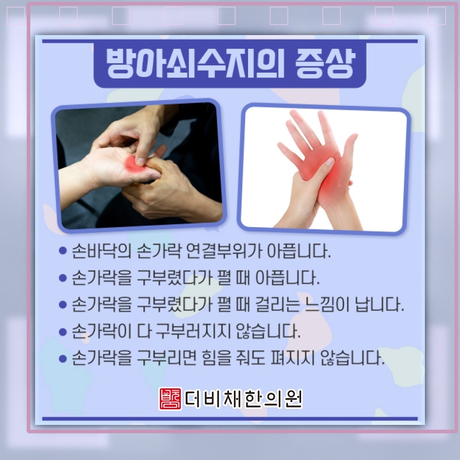 방아쇠수지로 손가락을 구부릴 때 느껴지는 걸림